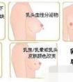 乳腺癌是如何引起的？