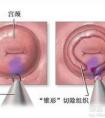 宮頸糜爛處一碰就出血