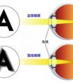 我的散光度數(shù)為什么會下降？