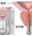 為什么前列腺炎這么難治療？