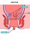 痔瘡是什么原因引起的