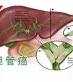 在福州市哪家醫(yī)院治療膽管癌比較好?