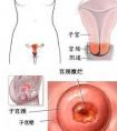 宮頸糜爛怎么治療