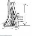 跟腱長度怎么量。
