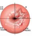 HPV和TCT之間的區(qū)別？