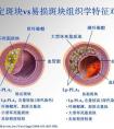 脂蛋白磷脂酶多高為正常