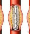 心臟支架國產(chǎn)的和進(jìn)口的有什么區(qū)別？