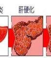 肝癌和肝硬化有什么區(qū)別呢